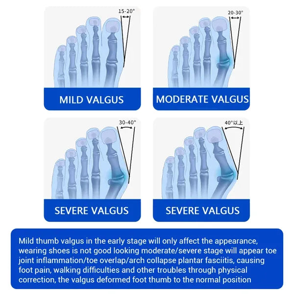 Finyra Bunion Correctors